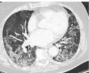 Fig. 1 – COVID-19 pneumonia. Transverse section of unenhanced chest CT scans showing typical lesions of COVID-19 pneumonia: ground glass associated with consolidation and intralobular lines, sometimes arcuate, with peripheral and declining predominance.