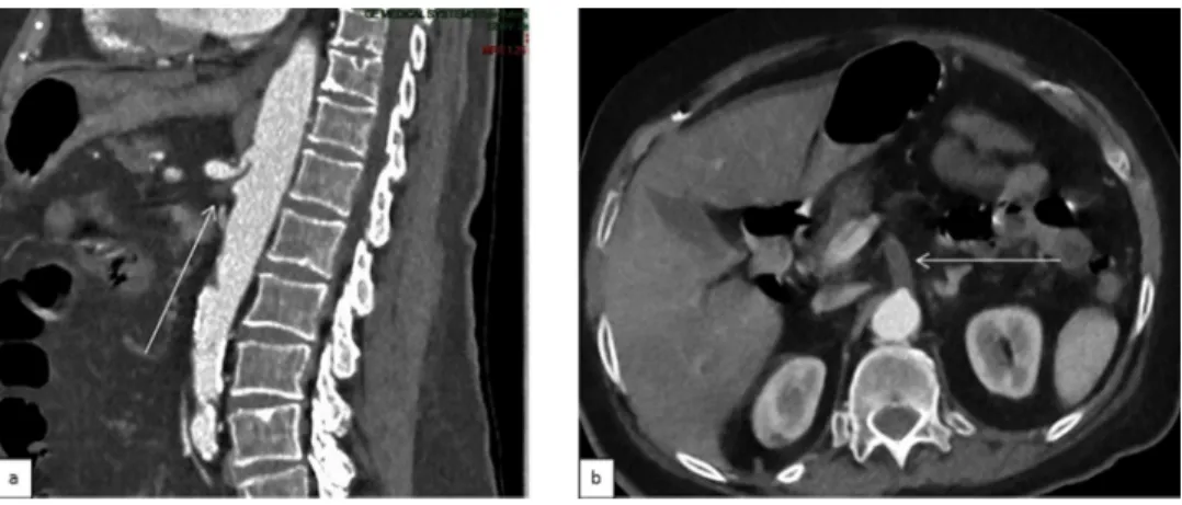 Fig. 3 – Imaging features of arterial thromboembolic disease in a 79-year-old COVID-19 patient