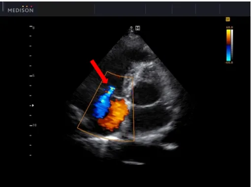 Figure 2.4: An example of color flow Doppler imaging of a mitral regurgitation. Image from http://www.medison.ru/uzi/eho562.htm