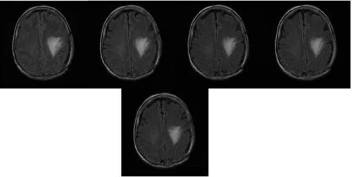 Figure 4.1 The examples of five MRI examinations of Patient 1 (FLAIR images)      (from top to bottom, from left to right corresponding to the first to the fifth period)