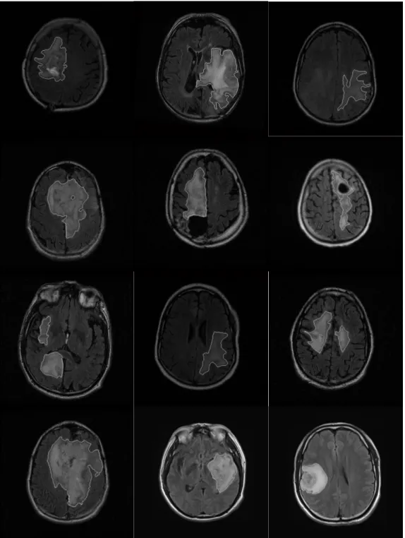 Figure 4.7 Tumor Segmentation results of Patient2 to Patient 13 (FLAIR images)   