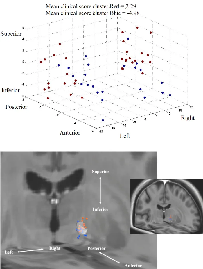 Fig. 5. STROOP analysis, with the cluster display in Talairach coordinates (above), and the cluster display  in the template space for the right hemisphere with the STN (below)