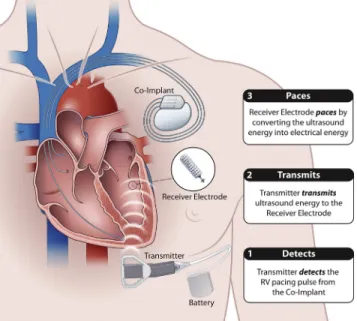 Figure 1 The WiSE-CRT pacing system.