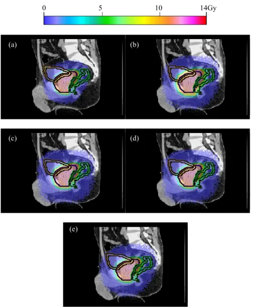 Figure 8.    Dose distributions in the prostate case using: (a) the nominal static fluence map; 