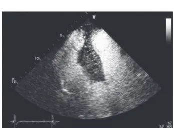 Figure 4. Contrast transthoracic echocardiography showing complete enhancement of the mass.