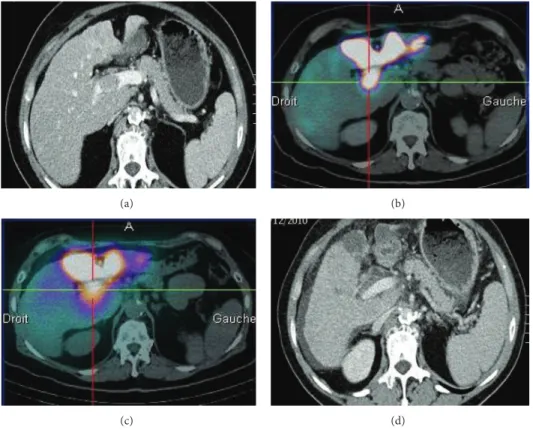 Figure 1: MAA SPECT/CT and CT scans showing implantation of microspheres in an PVTT and the involution of this PVTT ater radi- radi-oembolization: (a) Baseline CT scan, (b) MAA SPECT/CT showing a high MAA uptake in the PVTT, (c) Posttherapeutic Bremsstrahl