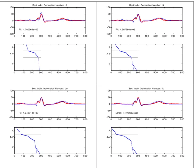 Figure 6. Adaptation of the model to a beat presenting a left bundle branch block obtained from record  111 of the MIT-BIH database