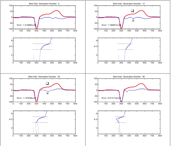 Figure 7. Application of the intra-beat adaptation algorithm to a premature ventricular contraction  in record 100 of the MIT-BIH database