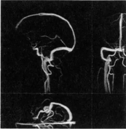 Figure  4-1:  Maximum  intensity  projection  of  a  phase-contrast  MRA  image  of  blood vessels  in the  brain.