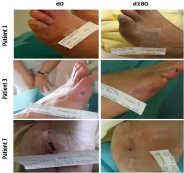 Figure 23: Images d'ulcères de la plaie des patients ayant reçu une injection intramusculaire des CSMs d‘origine  adipeuse [160]