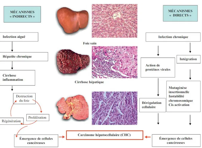 Figure 18 : Infection chronique par le VHB et carcinogenèse hépatique. Le développement du carcinome  hépatocellulaire  résulte  de  l’association  de  deux  composantes,  une  composante  immuno-dépendante  (mécanismes indirects) à l’origine d’une cytolys