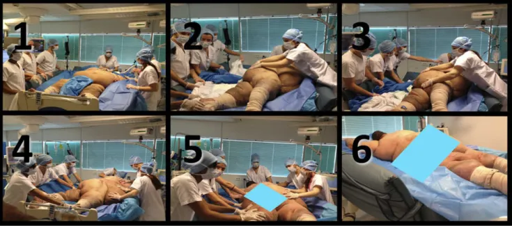 Figure  1. Steps of switch from supine to prone position in an obese patient. Step 1, The   patient is lying down, under deep sedation and  analgesia (Richmond Agitation and Sedation Scale score:   2 5, Behavioral Pain Scale score, 3)