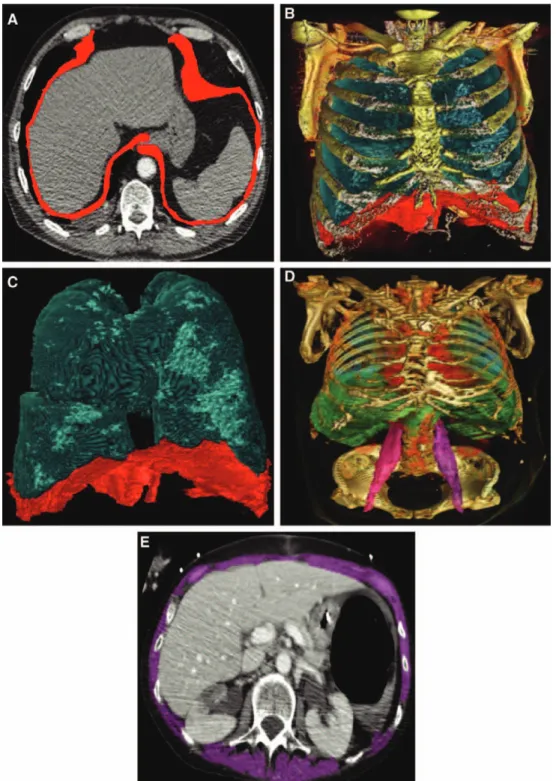 Fig. 3. Psoas and diaphragm volume measurements with three-dimensional computed tomography reconstruction and dedi- dedi-cated software for volumetry measurement (Advantage Window 4.5 with Volume Viewer; General Electric, Milwaukee, WI)