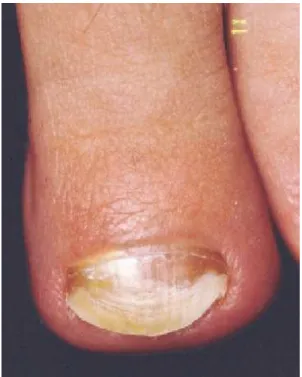 Figure 11 : Mélanonychie à Fusarium solani [Lee et al., 2002](65)