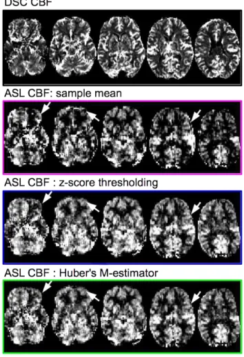 Figure 8: Example of robust CBF map in one patient: six axial slices. White arrows outlines large artefacts present in the averaged perfusion-weighted map and correctly  cor-rected by both z-score thresholding and M-estimator.
