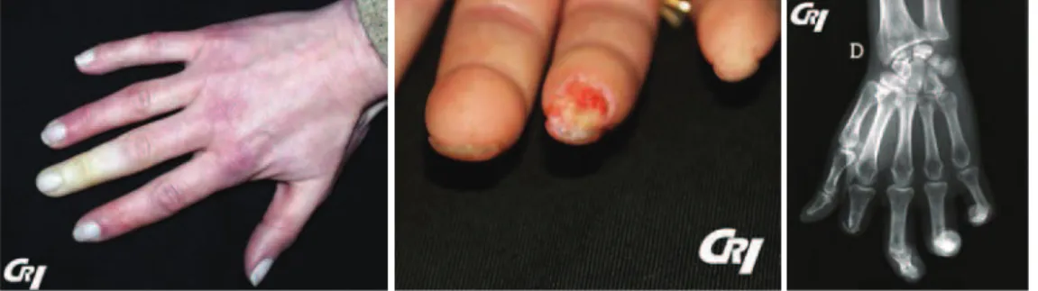 Figure 1 : Manifestations vasculaires distales dans la ScS. Phénomène de Raynaud en phase  syncopale ; Ulcérations ischémiques de la pulpe du 4ème doigt évoluant depuis 3 semaines  chez une patiente atteinte de sclérodermie systémique cutanée limitée avec 