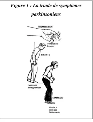 Figure 1 : La triade de symptômes  parkinsoniens 