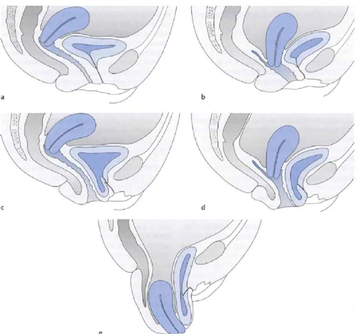 Figure 1-4 Les différents types de prolapsus avec a) anatomie normal; b) Prolapsus Utérovaginal léger; 