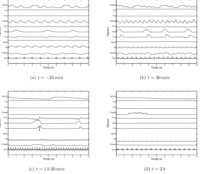 Fig. 4.8 – Evolution des signaux au cours de l’exp´erimentation sur des fenˆetres de 10 ´ s par rapport au temps t choc = 0 correspondant au d´ebut de la spoliation : Les formes des signaux changent au cours de l’exp´erimentation, n´eanmoins sur des fenˆet