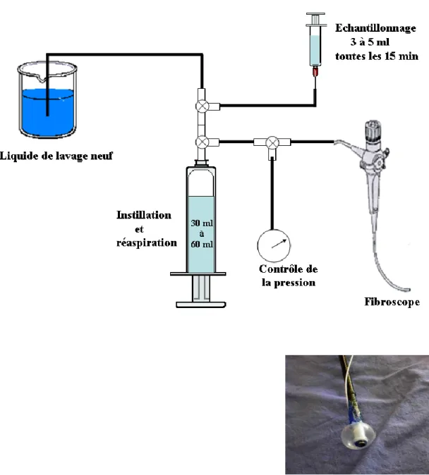 Figure 10 : Circuit de lavage broncho-alvéolaire. Le liquide de lavage neuf  est  contenu dans un réservoir