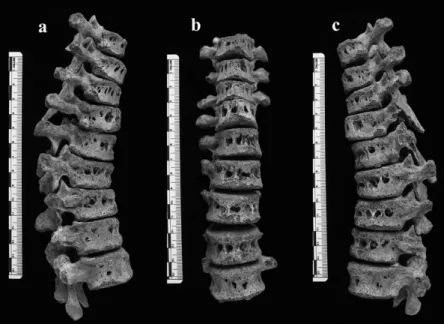 Figure 16 : vertèbres d’un squelette du 10 ème  – 13 ème  siècle, exhumé en Albanie (d’après Mutolo et  al)