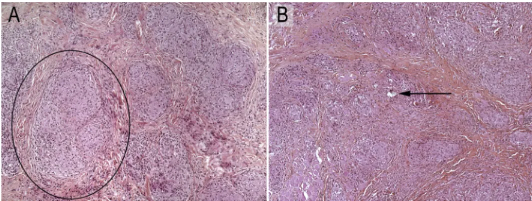 Fig. 1. Typical granulomas (black circle) without (A) and with (B) birefractile bodies (arrow) (H&amp;E 100).