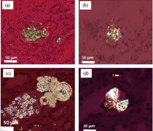 Fig. 7. Different aspects of dihydroxyadenine (a and c) and whewellite (b and d) crystallites in kidney biopsies.