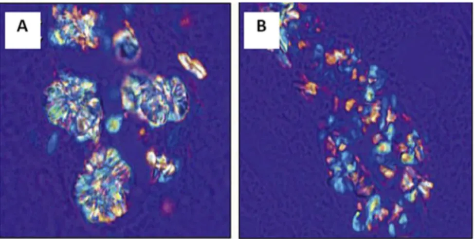 Fig. 11. Polarized light optical microscopy showed large rosette and radial shaped crystals in WT mouse kidney (A) and small and uniform crystals in the kidney of OPN KO mouse (B)