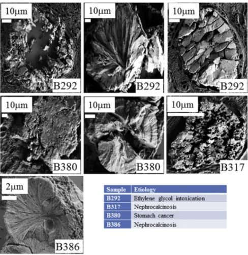 Fig. 9. Diversity of the crystallite morphologies observed for the different biopsies.