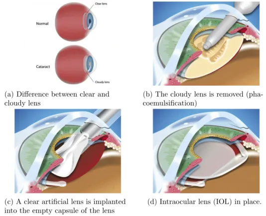 Figure 3.1: Main phases in the cataract surgery procedure. These images are a modified version of images got from this site 2 .