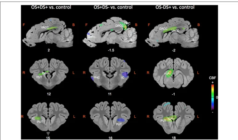 FIGURE 4 | Sagittal and coronal MRI sections showing clusters of differential cerebral blood flow identified during the small volume correction (SVC) analyses in different regions of interest chosen upon a priori hypotheses for the three following contrast