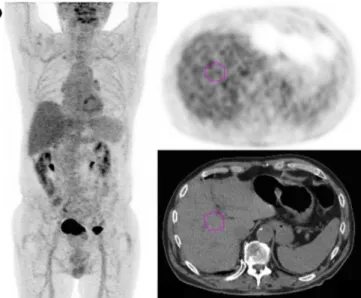 Fig. 4 Representative examples of steatotic (a) and non-steatotic (b) patients. Maximum intensity projection (MIP) and trans-hepatic axial PET and CT images of 67 year-old female steatotic patient addressed for an interim PET of DLBCL scored DS5 (a) and a 
