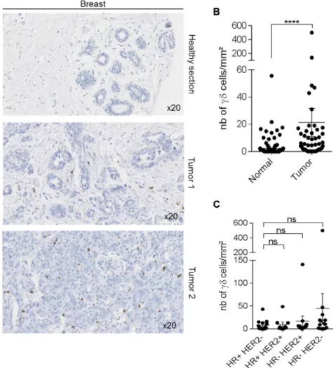 Figure 3. Detection of γδ T-cells in human breast samples. Immunohistochemical detection of γδ T- T-cells in 50 human breast cancer specimens