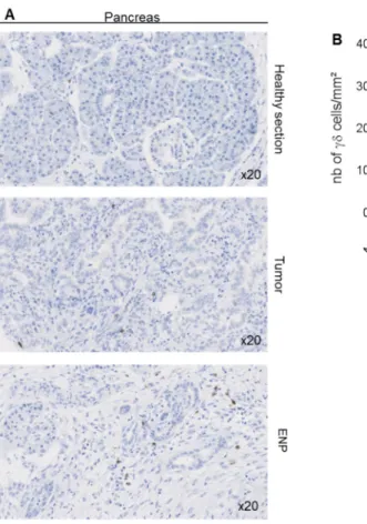 Figure 5. Detection of γδ T-cells in human pancreatic tissue samples. Immunohistochemical detection  of  γδ T-cells in 50 pancreatic adenocarcinomas, 31 adjacent normal pancreatic sections, and 10  epineoplastic pancreatitis (ENP) samples
