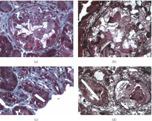 Figure 1: Foscarnet nephropathy in the kidney transplant. (a) Masson’s trichrome staining (×200) showed intraglomerular crystalline precipitation obstructing the capillaries and crushing the mesangium together with fibrinoid thrombi