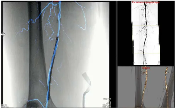 Fig.  5. Visualization of the navigation prototype UI.  Left: overlay of the angiographic panorama on the live image