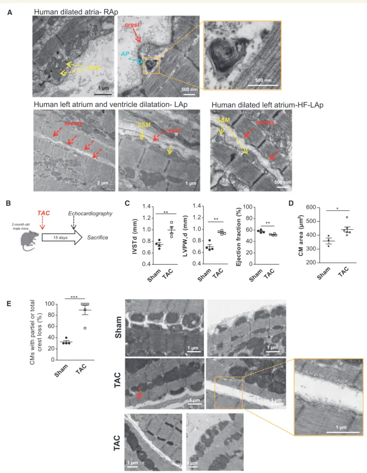 Figure 5 CM surface crest defects in cardiac diseases. (A) TEM micrographs of human Ap from hearts with various cardiac defects