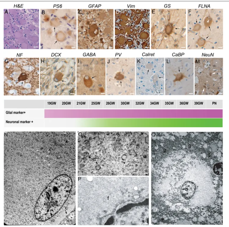 FIGURE 1 | Characterization of Giant cells. (A) Hematein-eosin staining of Giant cells displaying eosinophilic cytosols and flattened and decentered nuclei.