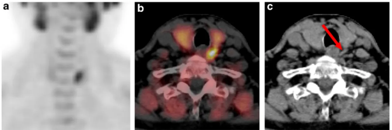 Fig. 4 MIBI SPECT/CT and FCH PET/CT images of a  68-y-old female patient with PHPT, an inconclusive cervical ultrasound report (dubious right inferior focus only visible on one plane) and a negative MIBI SPECT/CT.