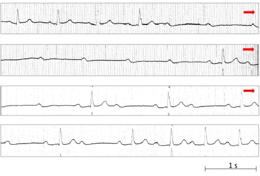 Figure 4. Case #6. The continuous ECG tracing (lead II) shows an episode of paroxysmal AV block