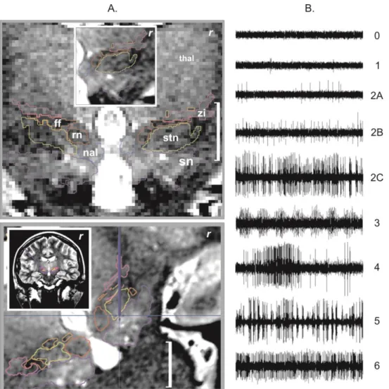 Figure  1.    A.  Example  of  stereotactic  MRI  anatomic  mapping  and  primary  targeting  (r,  right  hemisphere,  white  bar  =  1  cm):  (top)  anatomic  mapping  (label  +  outline)  on  a  coronal  T2  weighted slice (raw image), thalamus (thal), s