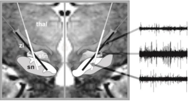 Figure 3:  Semi-schematic representation (on a real case) of intended trajectories planned based  on  our  direct  patient-by-patient  anatomic  mapping  (black  line)  and  based  on  a  classic  probabilistic atlas approach (white line; see example in Be