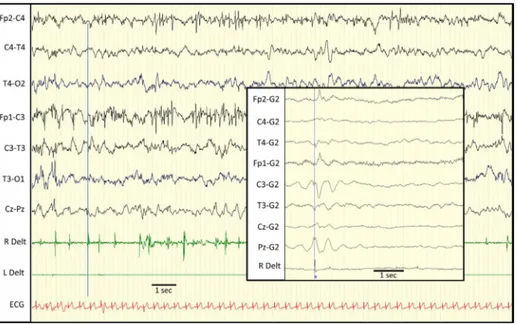 Figure 3 EEG recording of patient 2. Myoclonic partial status involving predominantly the right arm (R Delt: right deltoid)