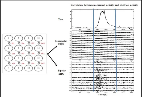 Figure 1.5: Digitized tocodynamometer paper (Top), monopolar signals (middle), corresponding  bipolar  signals  (bottom)