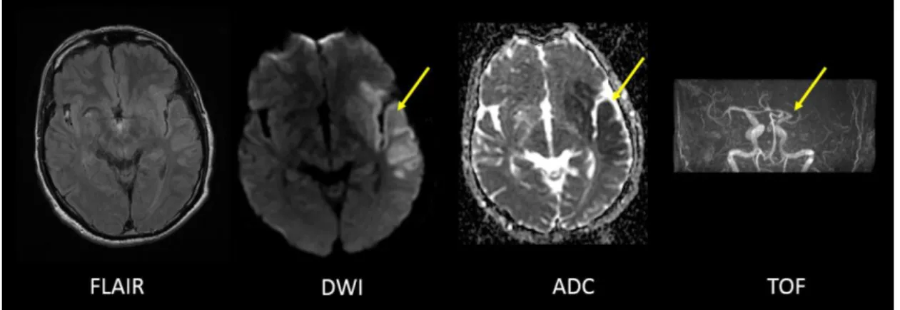Figure 11. MRI performed 2 hours after the ischemic stroke onset. Only discrete hypersignal  can be distinguished in the territory of left MCA on FLAIR sequence