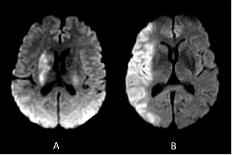 Figure  12.  Clinical  outcome  is  associated  with  stroke  location.  Initial  DWI  of  two  patients  with similar initial NIHSS scores but different functional outcomes