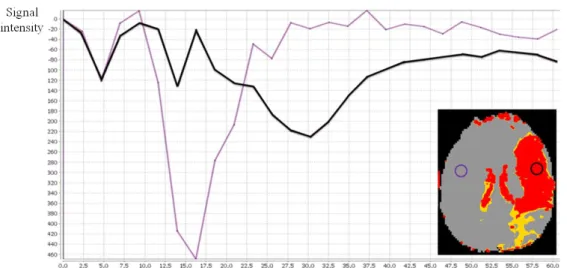 Figure 13. A: Diagram demonstrating the hemodynamic of the contrast agent obtained with  dynamic susceptibility contrast -MRI