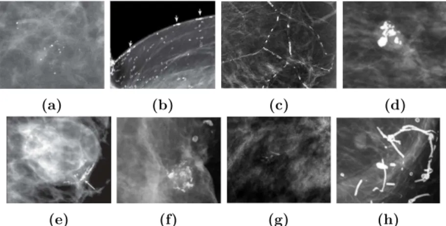 Figure 2.2: Examples of typically benign calcifications [105].(a) Round. (b) Skin. (c) Vascular