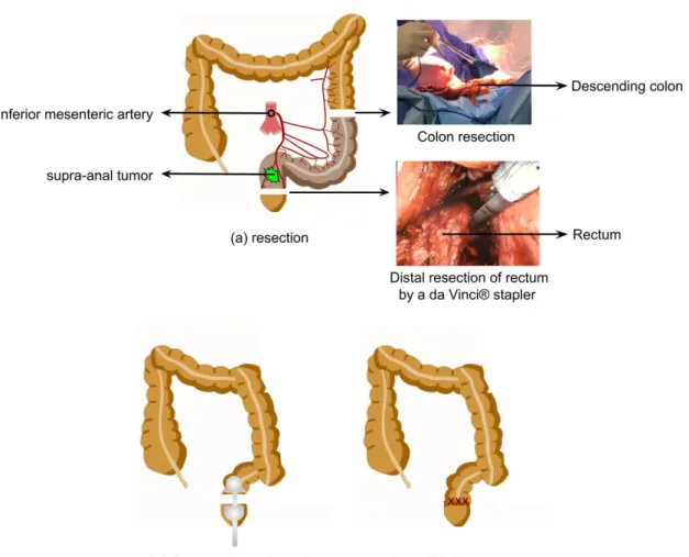 Figure 1.7 – Resection of supra-anal tumor and ultra-low colorectal anastomosis.