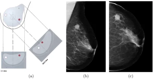 Figure 1.1: Mammography Medio-Lateral Oblique (MLO) and Cranio- Cranio-Caudal (CC) view points: (a) illustrates the projection of the two most used view points (image from [27]), which produces images like the  Medio-Lateral Oblique (MLO) in (b) and the Cr